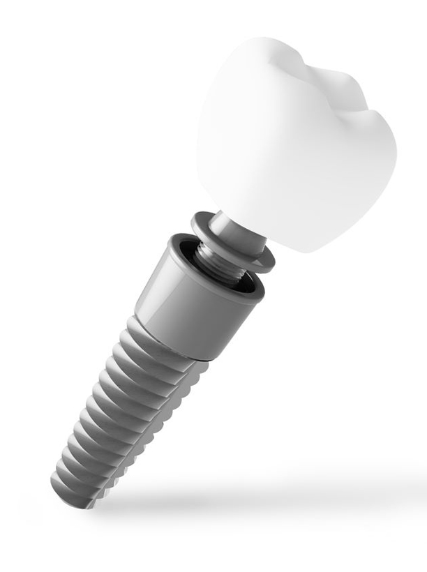 Dental Implant Services Thomas Dentistry